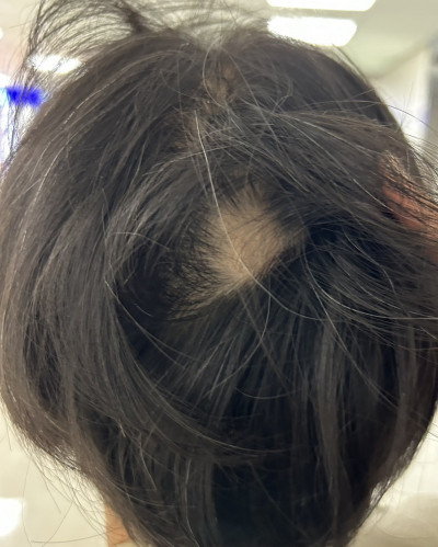 熬夜壓力大驚見「鬼剃頭」！中醫「針藥並施」調氣血、針灸活絡生髮