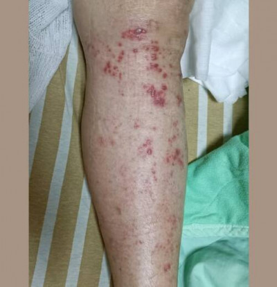 劇烈腳痛看骨科仍沒用 醫揪這病毒已擴散是真兇