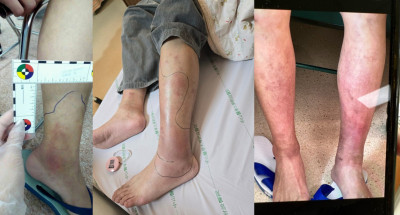 25歲男罹「活不過30歲」罕病 雙腿潰爛、敗血症纏身靠骨髓移植重生