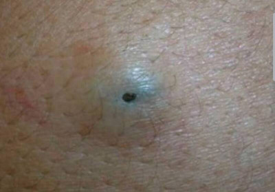 粉瘤擠出「臭乳酪」又滿血復活 醫揭沒除這東西是關鍵
