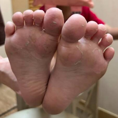 男童手腳猛脫皮嚇壞爸媽 醫揪這病毒是禍首