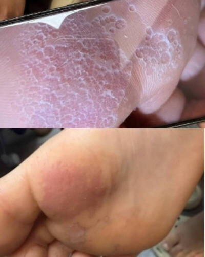 不是香港腳！ 醫揭腳臭冒小洞恐是「毒襪子症候群」