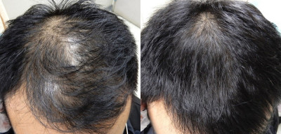 37歲上班族快禿成地中海  醫囑補充這食物、6週重現髮量