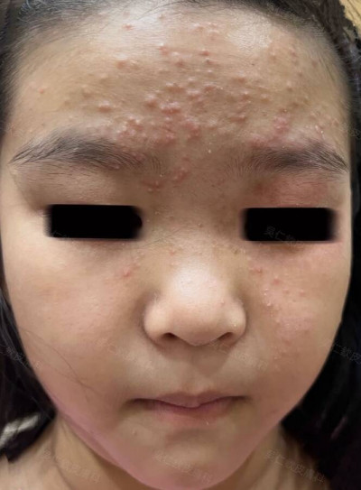 7歲女童滿臉爆痘花 媽媽崩潰急問性早熟 醫揪3元兇