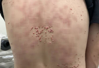 23歲男血糖失控 「黃色瘤」炸滿背 醫揪三酸甘油脂破6000