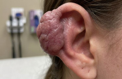 穿耳洞竟變「會長大的疤」！25歲女耳骨擠出肉球 醫揭「蟹足腫」釀禍