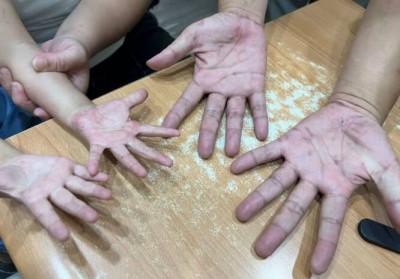 全家癢爆抓不停！ 醫揪「這蟲」是真兇 私密處也遭殃