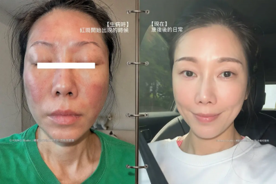 KIMIKO驚爆送急診！全身突冒紅斑、臉浮腫病因曝光：鬼門關走一遭