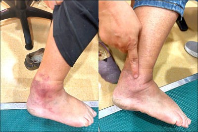 腳踝癢擦藥無效 元兇竟是下肢靜脈逆流