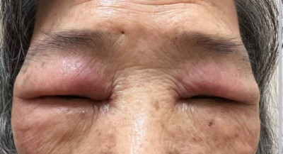 阿嬤眼皮腫到睜不開 醫揪削山藥惹禍：人人都可能中獎