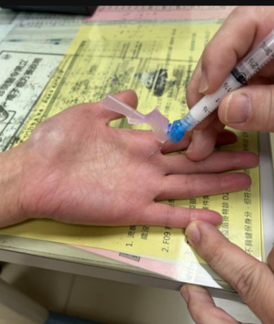 手指僵硬腫脹 小心「扳機指」！醫：拖一年逾半數無法自癒